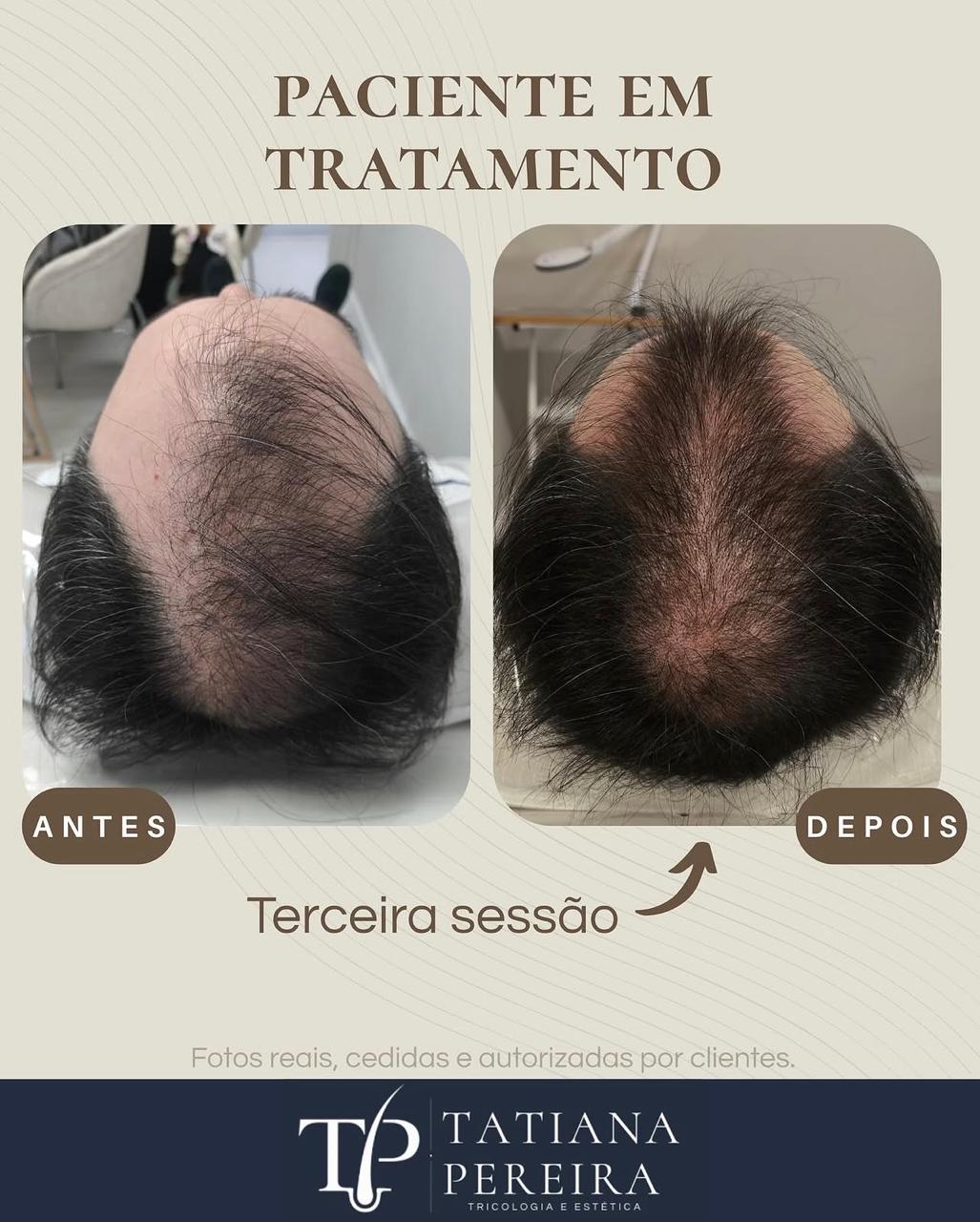 Resultado tratamento queda capilar masculina — paciente 3